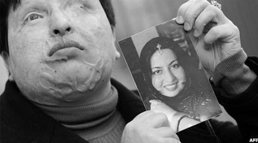 Acid Attack Blinded Man